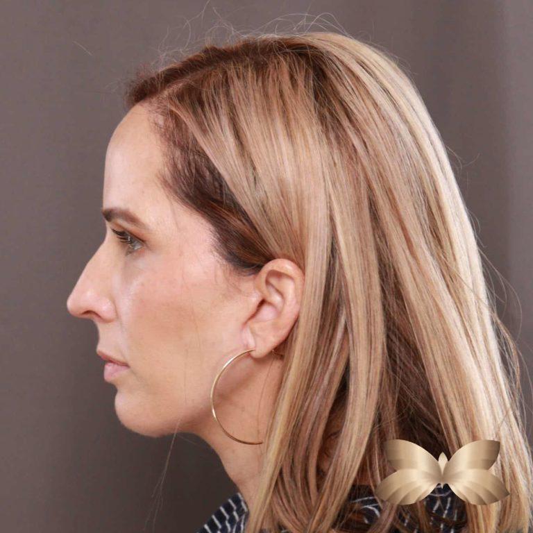 After Image: Facelift and Upper Eyelid Lift by: Dr. Thompson - left-side