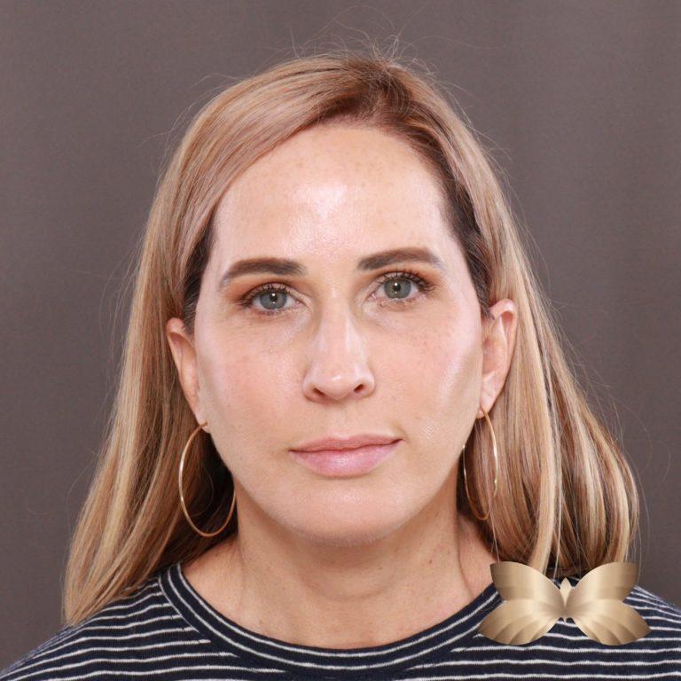 After Image: Facelift and Upper Eyelid Lift by: Dr. Thompson - front