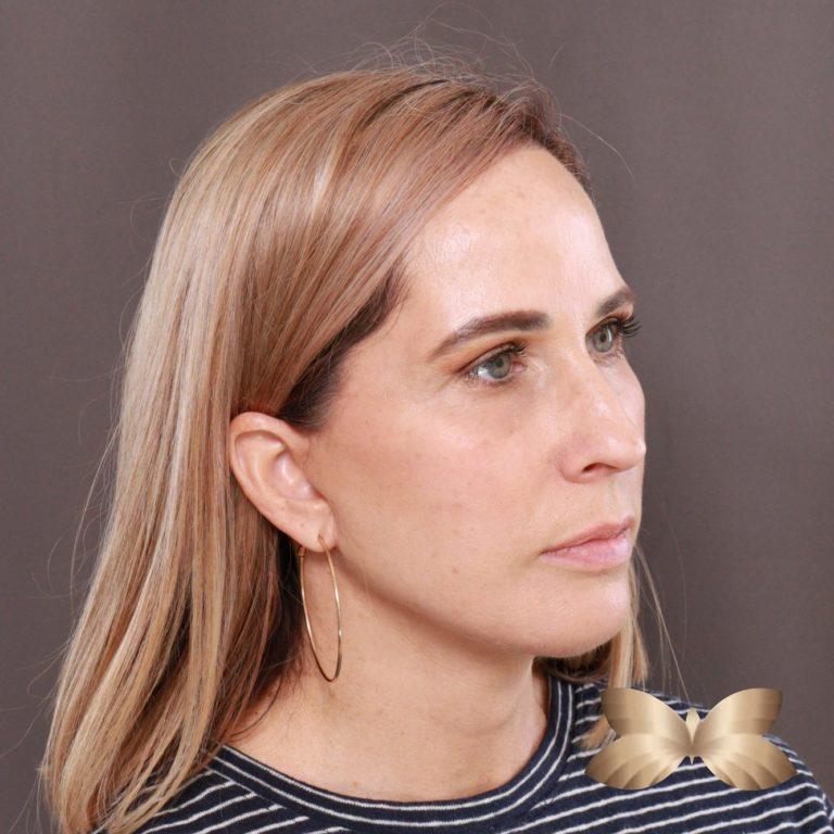 After Image: Facelift and Upper Eyelid Lift by: Dr. Thompson - right-front-oblique