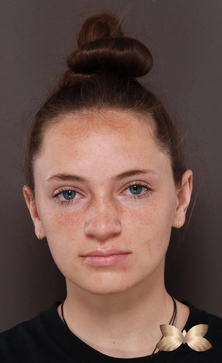 After Image: Otoplasty by: Dr. Thompson - front
