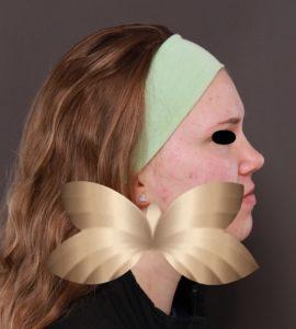 After Image: Chemical Peel and Collagen Induction Therapy by: Sarah