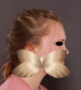 Before Image: Chemical Peel and Collagen Induction Therapy by: Sarah