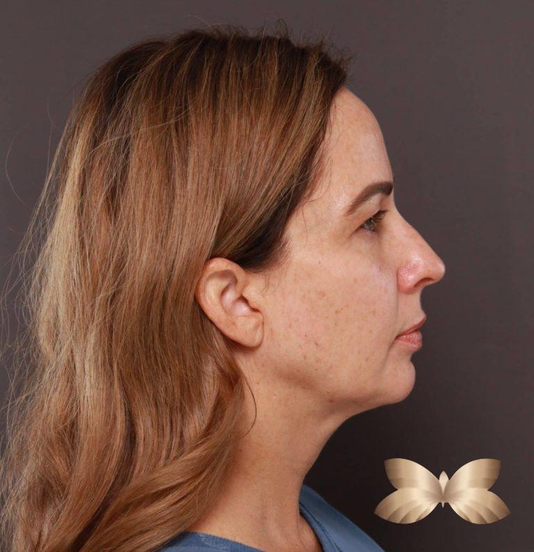 Before Image: Facelift and Upper Eyelid Lift by: Dr. Thompson - right-side