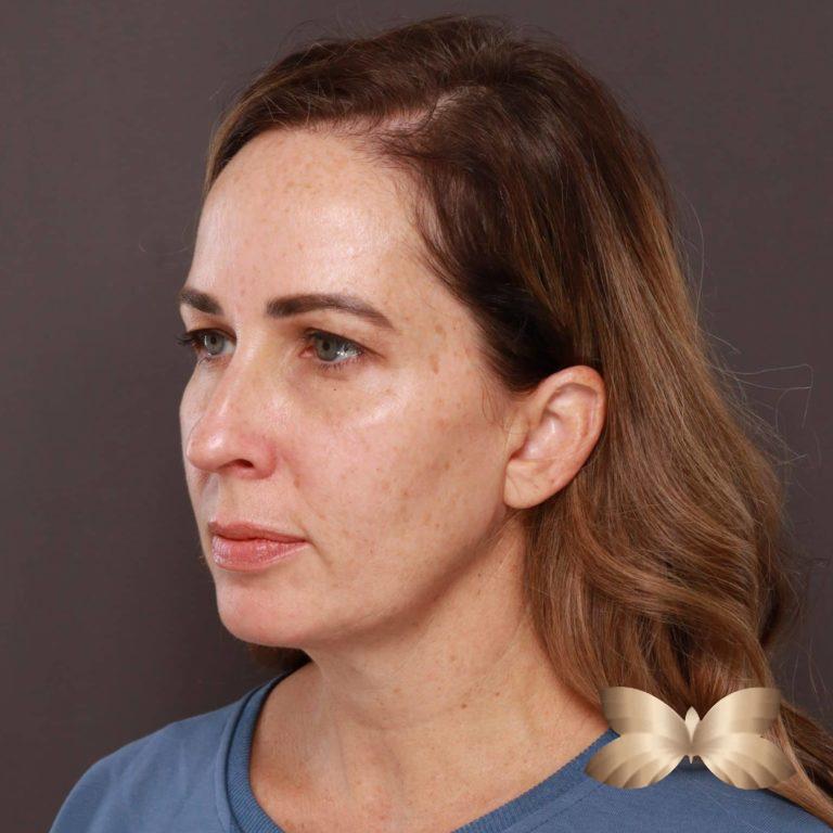 Before Image: Facelift and Upper Eyelid Lift by: Dr. Thompson - left-front-oblique