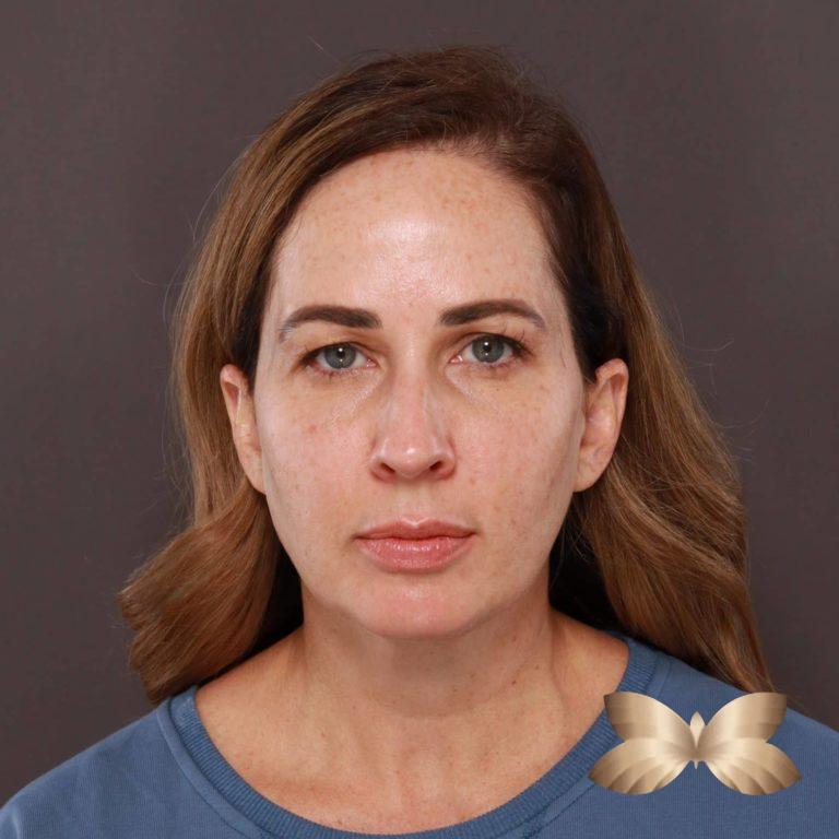 Before Image: Facelift and Upper Eyelid Lift by: Dr. Thompson - front