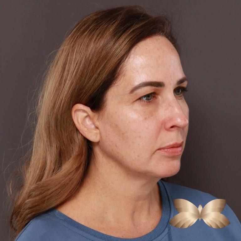 Before Image: Facelift and Upper Eyelid Lift by: Dr. Thompson - right-front-oblique