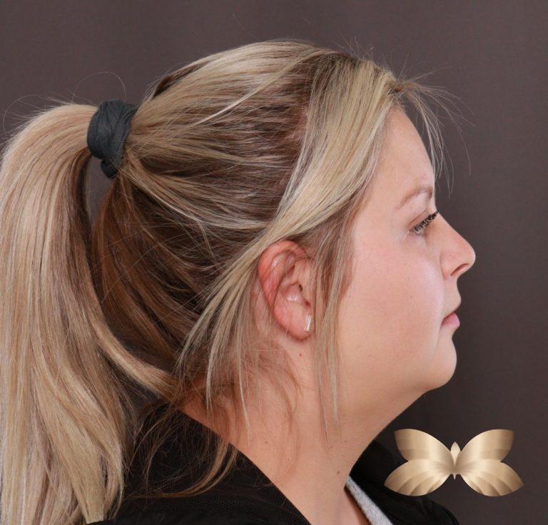 Before Image: Submental Liposuction by: Dr. Thompson - right-side