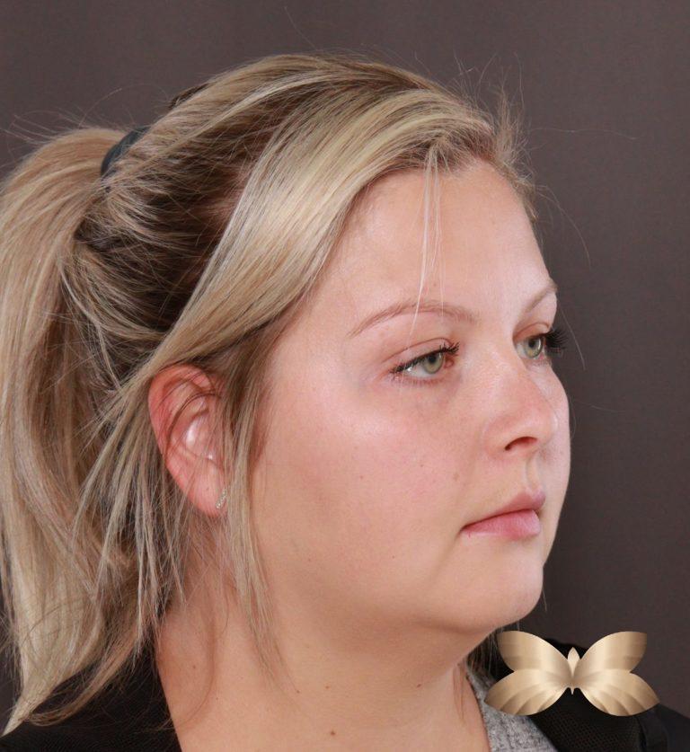 Before Image: Submental Liposuction by: Dr. Thompson - right-front-oblique