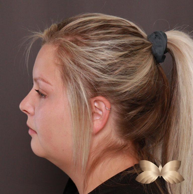 Before Image: Submental Liposuction by: Dr. Thompson - left-side
