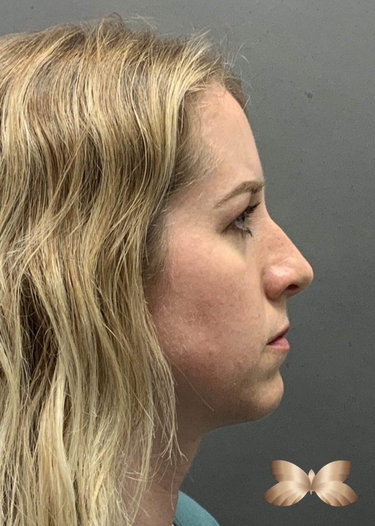 Before Image: Rhinoplasty by: Dr. Henstrom - right-side