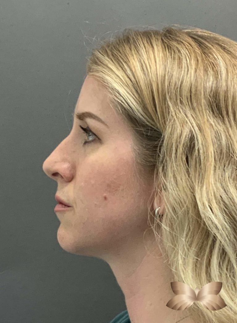 Before Image: Rhinoplasty by: Dr. Henstrom - left-side