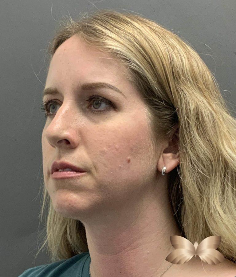 Before Image: Rhinoplasty by: Dr. Henstrom - left-front-oblique