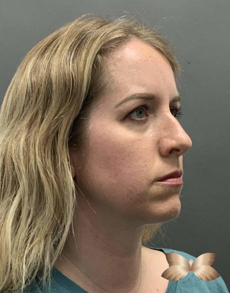 Before Image: Rhinoplasty by: Dr. Henstrom - right-front-oblique