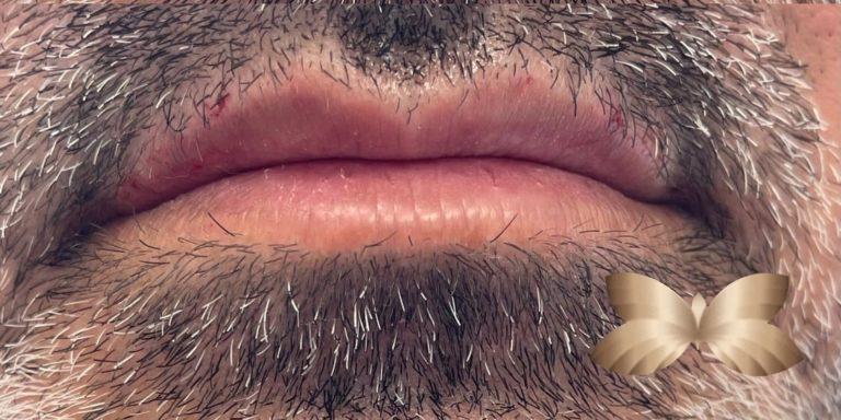 After Image: Lip Augmentation by: Nurse Injector - front