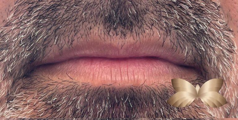 Before Image: Lip Augmentation by: Nurse Injector - front