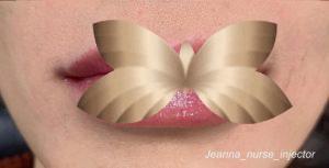 After Image: Lip Augmentation by: Jeanna