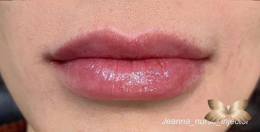Lip Augmentation by: Jeanna
