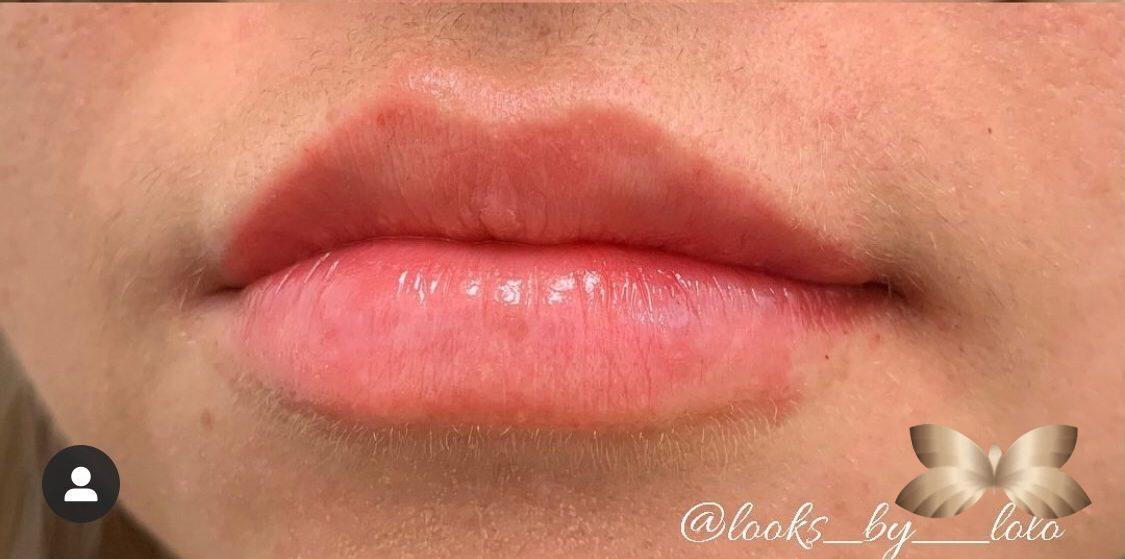 Lip Augmentation by: Nurse Injector Lauren