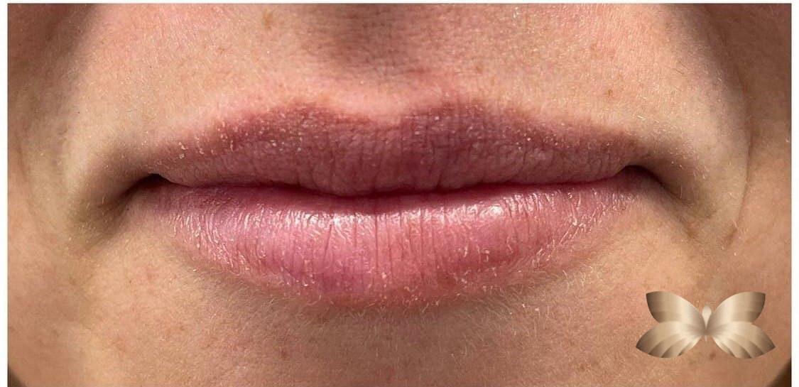 Lip Augmentation By UFP Nurse Injector Utah Facial Plastics