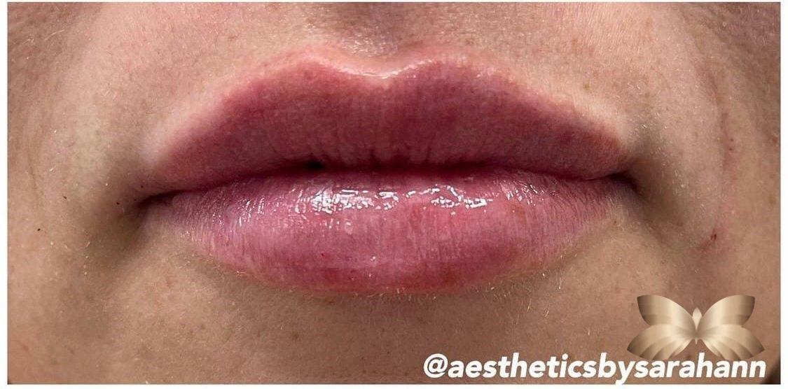 Lip Augmentation By UFP Nurse Injector Utah Facial Plastics
