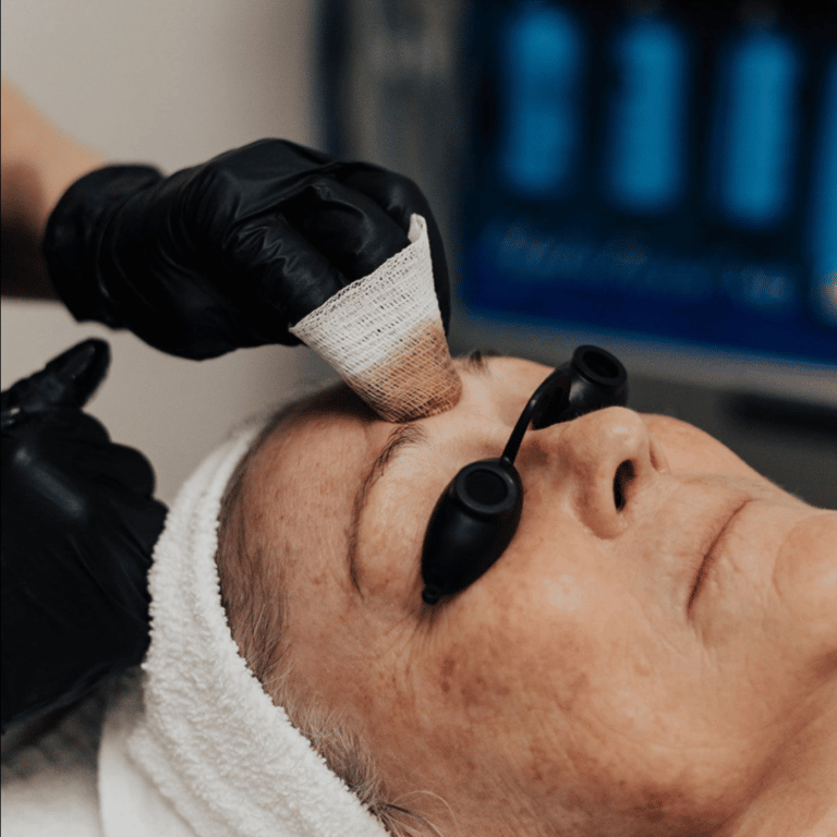 Best Treatments for Sunspot Removal Utah Facial Plastics