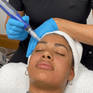 collagen induction therapy 712