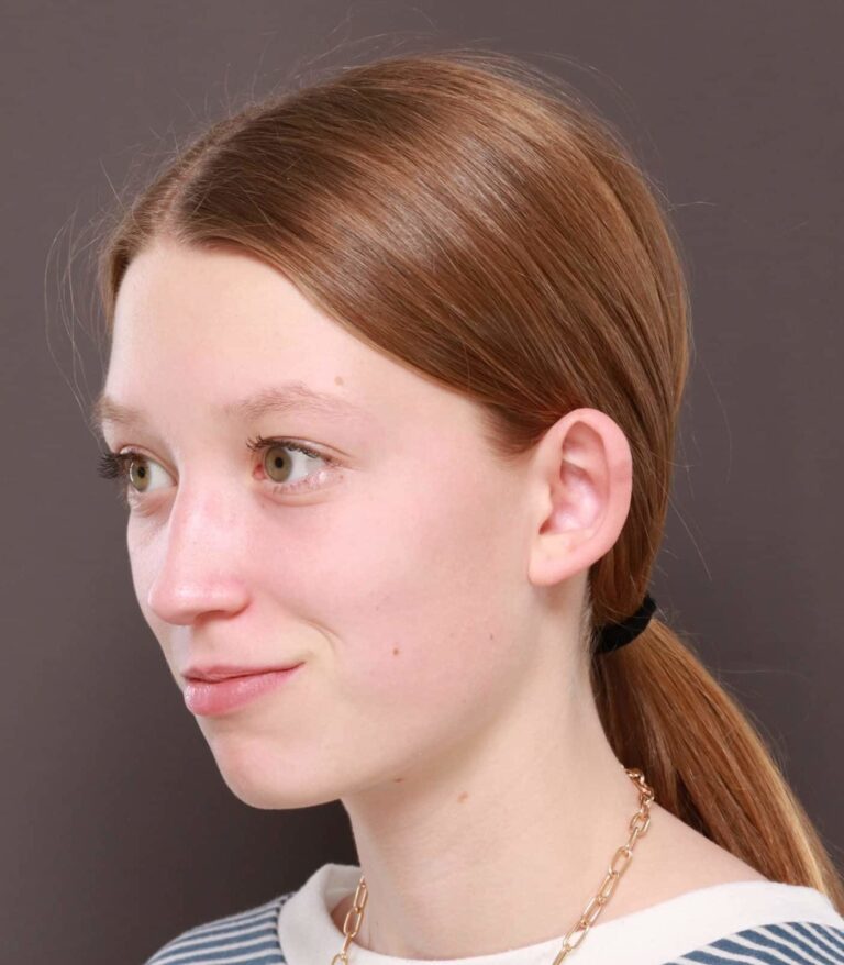 Before Image: Otoplasty by: Dr. Thompson - left-front-oblique