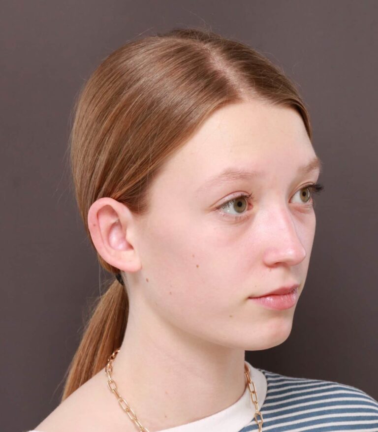 Before Image: Otoplasty by: Dr. Thompson - right-front-oblique