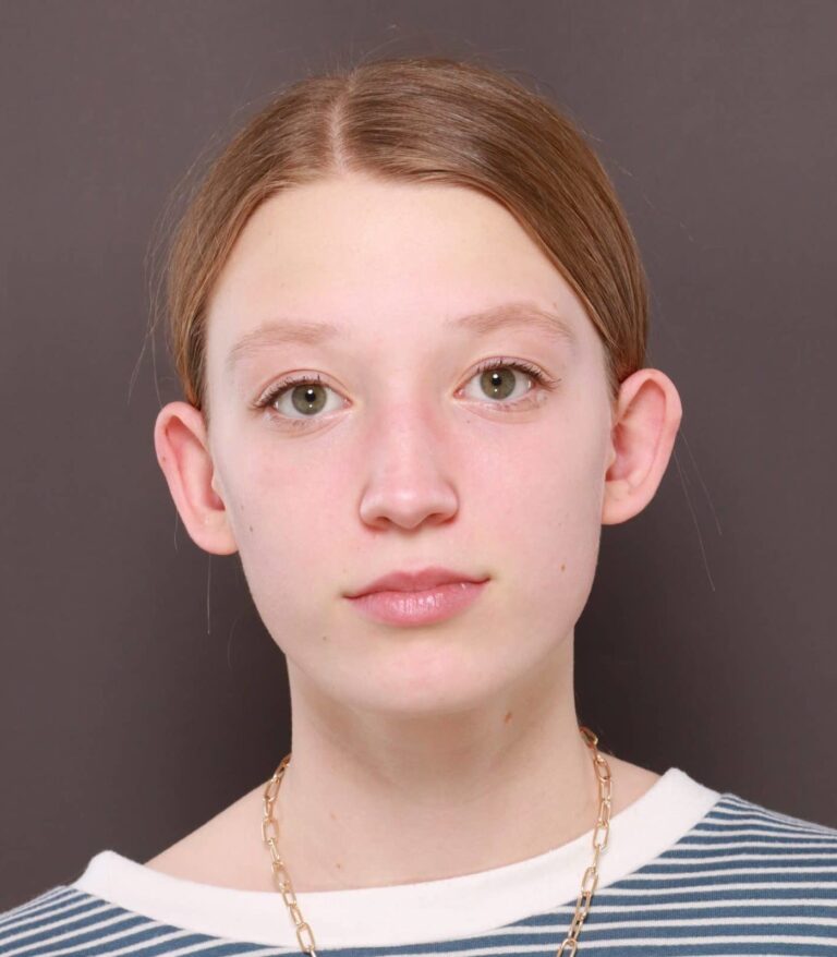 Before Image: Otoplasty by: Dr. Thompson - front