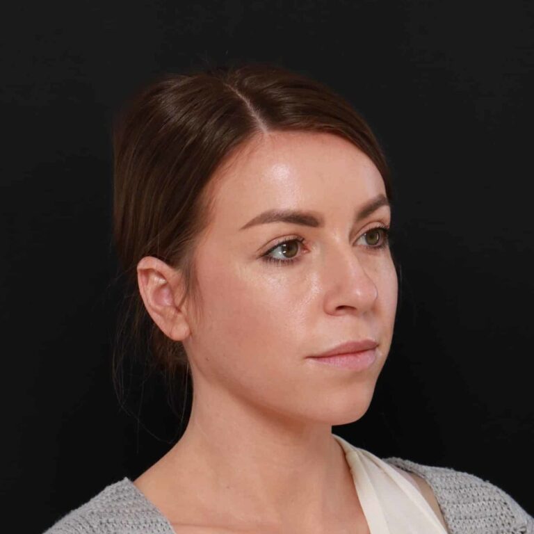 Before Image: Rhinoplasty by: Dr. Henstrom - right-front-oblique