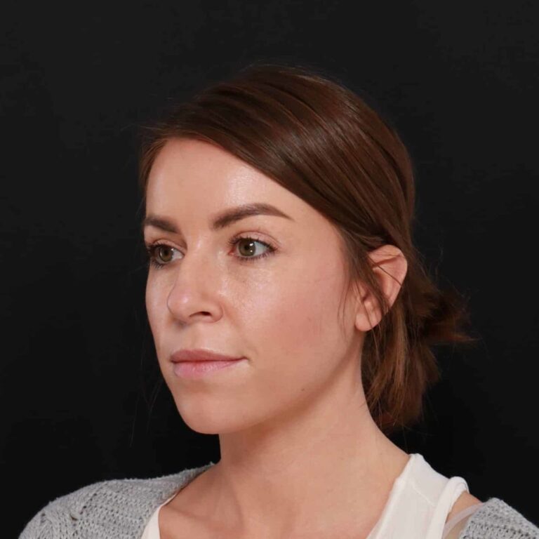 Before Image: Rhinoplasty by: Dr. Henstrom - left-front-oblique