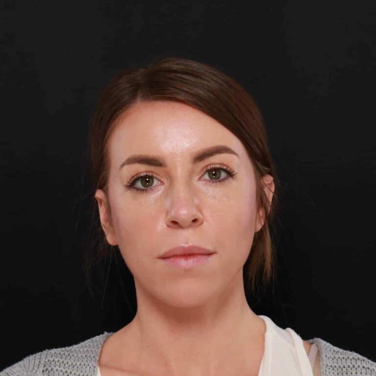 Before Image: Rhinoplasty by: Dr. Henstrom - front