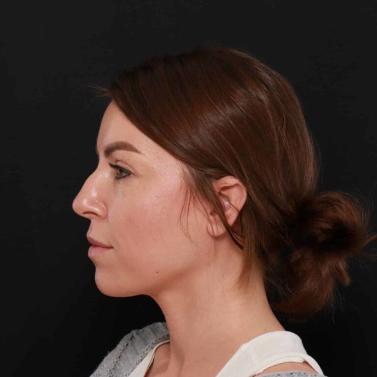 Before Image: Rhinoplasty by: Dr. Henstrom - left-side