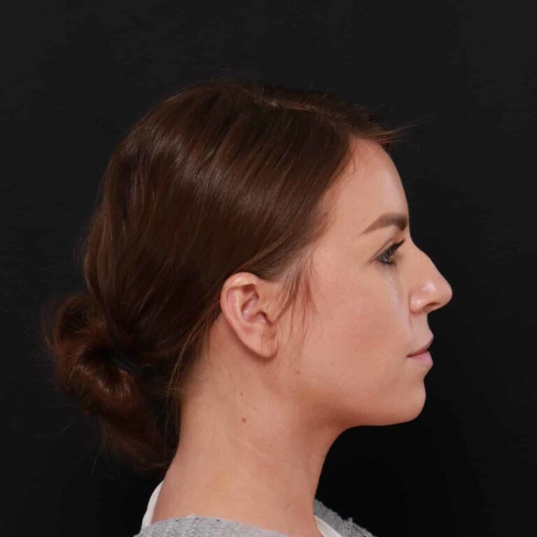 Before Image: Rhinoplasty by: Dr. Henstrom - right-side