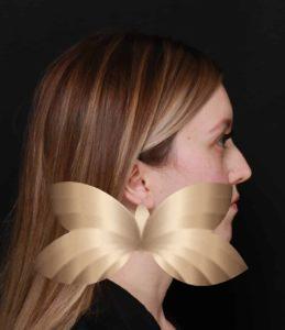 Before Image: Septoplasty/Rhinoplasty by: Dr. Henstrom