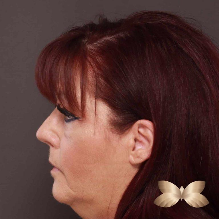 After Image: Rhinoplasty/Septoplasty by: Dr. Thompson - left-side