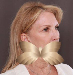 Before Image: Facelift and Forehead Lift by: Dr. Thompson