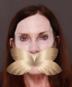 Sculptra by: Nurse Injector Kayla