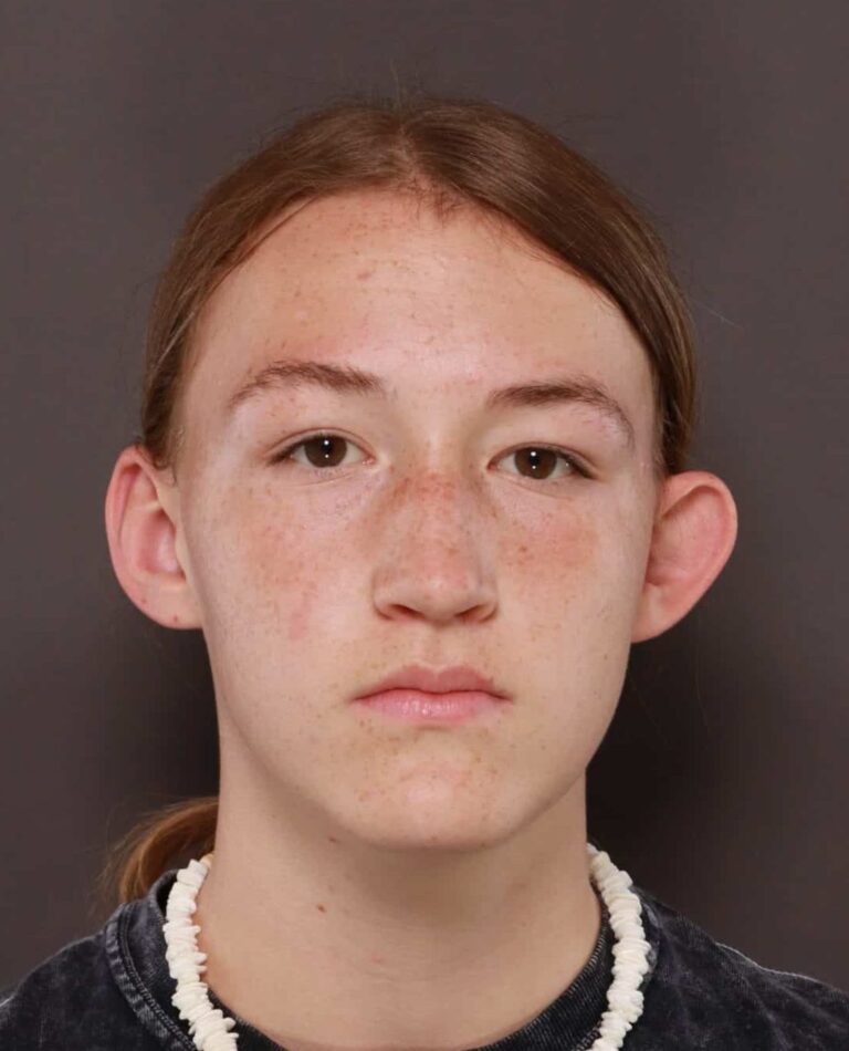 Before Image: Otoplasty by: Dr. Thompson - front