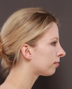 Before Image: Revision Rhinoplasty and Chin Implant by Dr. Henstrom