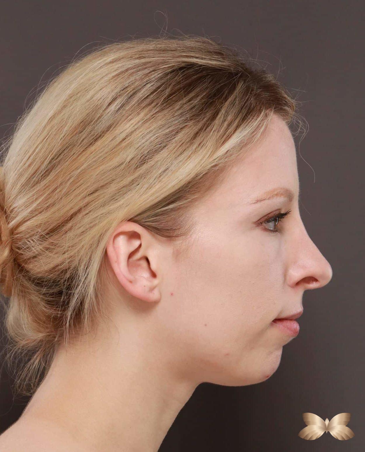 Revision Rhinoplasty and Chin Implant by: Dr. Henstrom