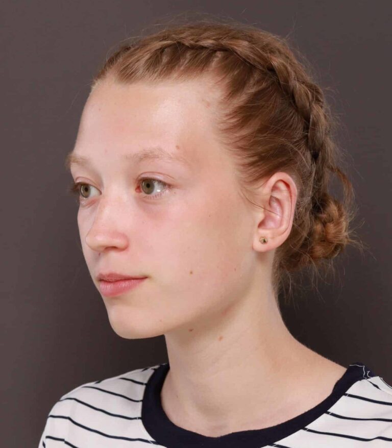 After Image: Otoplasty by: Dr. Thompson - left-front-oblique