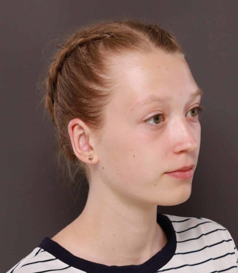 After Image: Otoplasty by: Dr. Thompson - right-front-oblique