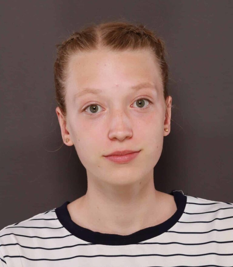 After Image: Otoplasty by: Dr. Thompson - front