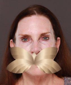 Sculptra by: Nurse Injector Kayla
