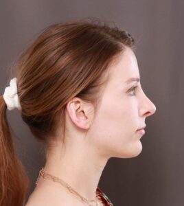 After Image: Revision Rhinoplasty and Chin Implant by Dr. Henstrom