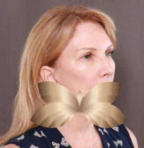 After Image: Facelift and Forehead Lift by: Dr. Thompson