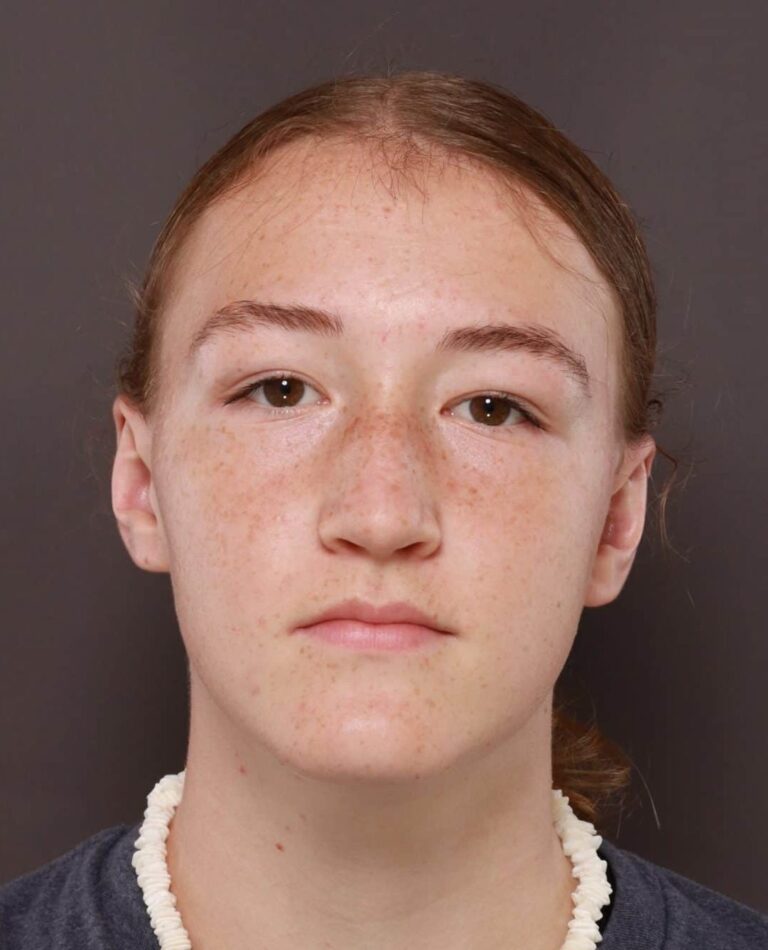 After Image: Otoplasty by: Dr. Thompson - front