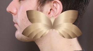 Kybella and Chin Augmentation by: Alfie