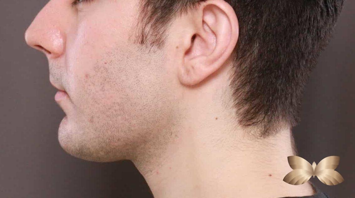 Kybella and Chin Augmentation by: Alfie